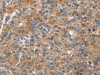 The image on the left is immunohistochemistry of paraffin-embedded Human liver cancer tissue using CSB-PA173074 (CAPZA1 Antibody) at dilution 1/25, on the right is treated with synthetic peptide. (Original magnification: ×200) The image on the left is immunohistochemistry of paraffin-embedded Human liver cancer tissue using CSB-PA173074 (CAPZA1 Antibody) at dilution 1/25, on the right is treated with synthetic peptide. (Original magnification: ×200)