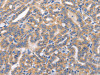The image on the left is immunohistochemistry of paraffin-embedded Human thyroid cancer tissue using CSB-PA680389 (CARD17 Antibody) at dilution 1/50, on the right is treated with synthetic peptide. (Original magnification: ×200)