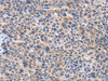 The image on the left is immunohistochemistry of paraffin-embedded Human liver cancer tissue using CSB-PA680389 (CARD17 Antibody) at dilution 1/50, on the right is treated with synthetic peptide. (Original magnification: ×200)
