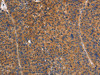 The image on the left is immunohistochemistry of paraffin-embedded Human liver cancer tissue using CSB-PA876477 (NOD1 Antibody) at dilution 1/50, on the right is treated with synthetic peptide. (Original magnification: ×200)