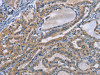The image on the left is immunohistochemistry of paraffin-embedded Human thyroid cancer tissue using CSB-PA172042 (TNFRSF8 Antibody) at dilution 1/50, on the right is treated with synthetic peptide. (Original magnification: ×200)