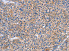 The image on the left is immunohistochemistry of paraffin-embedded Human liver cancer tissue using CSB-PA803018 (SIGLEC7 Antibody) at dilution 1/50, on the right is treated with synthetic peptide. (Original magnification: ×200) The image on the left is immunohistochemistry of paraffin-embedded Human liver cancer tissue using CSB-PA803018 (SIGLEC7 Antibody) at dilution 1/50, on the right is treated with synthetic peptide. (Original magnification: ×200)