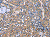 The image on the left is immunohistochemistry of paraffin-embedded Human thyroid cancer tissue using CSB-PA803018 (SIGLEC7 Antibody) at dilution 1/50, on the right is treated with synthetic peptide. (Original magnification: ×200) The image on the left is immunohistochemistry of paraffin-embedded Human thyroid cancer tissue using CSB-PA803018 (SIGLEC7 Antibody) at dilution 1/50, on the right is treated with synthetic peptide. (Original magnification: ×200)