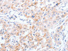The image on the left is immunohistochemistry of paraffin-embedded Human lung cancer tissue using CSB-PA166219 (SCARB1 Antibody) at dilution 1/30, on the right is treated with synthetic peptide. (Original magnification: ×200)