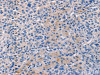 The image on the left is immunohistochemistry of paraffin-embedded Human liver cancer tissue using CSB-PA563352 (CD5L Antibody) at dilution 1/40, on the right is treated with synthetic peptide. (Original magnification: ×200)
