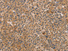 The image on the left is immunohistochemistry of paraffin-embedded Human liver cancer tissue using CSB-PA105838 (CDK11A/CDK11B Antibody) at dilution 1/40, on the right is treated with synthetic peptide. (Original magnification: ×200)
