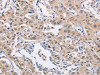 The image on the left is immunohistochemistry of paraffin-embedded Human lung cancer tissue using CSB-PA924477 (CDC34 Antibody) at dilution 1/40, on the right is treated with synthetic peptide. (Original magnification: ×200)