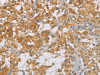 The image on the left is immunohistochemistry of paraffin-embedded Human thyroid cancer tissue using CSB-PA445592 (CDKN2A Antibody) at dilution 1/60, on the right is treated with synthetic peptide. (Original magnification: ×200)