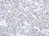 The image on the left is immunohistochemistry of paraffin-embedded Human thyroid cancer tissue using CSB-PA106715 (AGAP2 Antibody) at dilution 1/60, on the right is treated with synthetic peptide. (Original magnification: ×200)