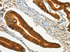 The image on the left is immunohistochemistry of paraffin-embedded Human colon cancer tissue using CSB-PA800200 (CHRDL2 Antibody) at dilution 1/20, on the right is treated with synthetic peptide. (Original magnification: ×200)