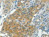 The image on the left is immunohistochemistry of paraffin-embedded Human liver cancer tissue using CSB-PA168970 (CHRNA2 Antibody) at dilution 1/30, on the right is treated with synthetic peptide. (Original magnification: ×200) The image on the left is immunohistochemistry of paraffin-embedded Human liver cancer tissue using CSB-PA168970 (CHRNA2 Antibody) at dilution 1/30, on the right is treated with synthetic peptide. (Original magnification: ×200)
