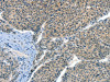 The image on the left is immunohistochemistry of paraffin-embedded Human liver cancer tissue using CSB-PA976066 (CRLF2 Antibody) at dilution 1/60, on the right is treated with synthetic peptide. (Original magnification: ×200)