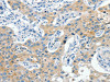 The image on the left is immunohistochemistry of paraffin-embedded Human lung cancer tissue using CSB-PA291126 (CNTNAP3 Antibody) at dilution 1/40, on the right is treated with synthetic peptide. (Original magnification: ×200)