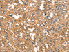 The image on the left is immunohistochemistry of paraffin-embedded Human thyroid cancer tissue using CSB-PA255746 (CRELD1 Antibody) at dilution 1/40, on the right is treated with synthetic peptide. (Original magnification: ×200)