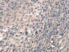 The image on the left is immunohistochemistry of paraffin-embedded Human cervical cancer tissue using CSB-PA998940 (CDK12 Antibody) at dilution 1/30, on the right is treated with synthetic peptide. (Original magnification: ×200)