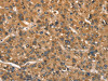 The image on the left is immunohistochemistry of paraffin-embedded Human liver cancer tissue using CSB-PA445499 (CSTB Antibody) at dilution 1/30, on the right is treated with synthetic peptide. (Original magnification: ×200)