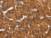 The image on the left is immunohistochemistry of paraffin-embedded Human liver cancer tissue using CSB-PA214597 (MT-CYB Antibody) at dilution 1/50, on the right is treated with synthetic peptide. (Original magnification: ×200)