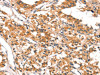 The image on the left is immunohistochemistry of paraffin-embedded Human thyroid cancer tissue using CSB-PA167820 (DAB2IP Antibody) at dilution 1/20, on the right is treated with synthetic peptide. (Original magnification: ×200) The image on the left is immunohistochemistry of paraffin-embedded Human thyroid cancer tissue using CSB-PA167820 (DAB2IP Antibody) at dilution 1/20, on the right is treated with synthetic peptide. (Original magnification: ×200)