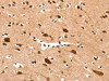 The image on the left is immunohistochemistry of paraffin-embedded Human brain tissue using CSB-PA572968 (DDX4 Antibody) at dilution 1/25, on the right is treated with synthetic peptide. (Original magnification: ×200)