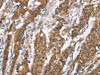 The image on the left is immunohistochemistry of paraffin-embedded Human gastic cancer tissue using CSB-PA229519 (DSC2 Antibody) at dilution 1/25, on the right is treated with synthetic peptide. (Original magnification: ×200)