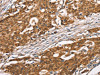 The image on the left is immunohistochemistry of paraffin-embedded Human gastric cancer tissue using CSB-PA932813 (DGAT1 Antibody) at dilution 1/40, on the right is treated with synthetic peptide. (Original magnification: ×200) The image on the left is immunohistochemistry of paraffin-embedded Human gastric cancer tissue using CSB-PA932813 (DGAT1 Antibody) at dilution 1/40, on the right is treated with synthetic peptide. (Original magnification: ×200)
