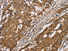 The image on the left is immunohistochemistry of paraffin-embedded Human gastic cancer tissue using CSB-PA556009 (DICER1 Antibody) at dilution 1/40, on the right is treated with synthetic peptide. (Original magnification: ×200)