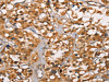 The image on the left is immunohistochemistry of paraffin-embedded Human thyroid cancer tissue using CSB-PA556009 (DICER1 Antibody) at dilution 1/40, on the right is treated with synthetic peptide. (Original magnification: ×200)