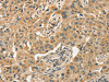 The image on the left is immunohistochemistry of paraffin-embedded Human lung cancer tissue using CSB-PA992341 (SLC11A2 Antibody) at dilution 1/50, on the right is treated with synthetic peptide. (Original magnification: ×200)