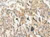 The image on the left is immunohistochemistry of paraffin-embedded Human esophagus cancer tissue using CSB-PA992341 (SLC11A2 Antibody) at dilution 1/50, on the right is treated with synthetic peptide. (Original magnification: ×200)