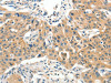 The image on the left is immunohistochemistry of paraffin-embedded Human lung cancer tissue using CSB-PA155558 (SLC11A2 Antibody) at dilution 1/65, on the right is treated with synthetic peptide. (Original magnification: ×200)