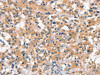 The image on the left is immunohistochemistry of paraffin-embedded Human thyroid cancer tissue using CSB-PA693996 (EID3 Antibody) at dilution 1/15, on the right is treated with synthetic peptide. (Original magnification: ×200)