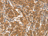 The image on the left is immunohistochemistry of paraffin-embedded Human gastic cancer tissue using CSB-PA731077 (EID3 Antibody) at dilution 1/15, on the right is treated with synthetic peptide. (Original magnification: ×200)