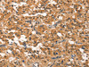 The image on the left is immunohistochemistry of paraffin-embedded Human thyroid cancer tissue using CSB-PA731077 (EID3 Antibody) at dilution 1/15, on the right is treated with synthetic peptide. (Original magnification: ×200)