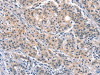 The image on the left is immunohistochemistry of paraffin-embedded Human gastic cancer tissue using CSB-PA223936 (ELOVL6 Antibody) at dilution 1/40, on the right is treated with synthetic peptide. (Original magnification: ×200)