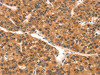 The image on the left is immunohistochemistry of paraffin-embedded Human liver cancer tissue using CSB-PA584449 (EPPIN Antibody) at dilution 1/25, on the right is treated with synthetic peptide. (Original magnification: ×200)