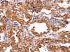 The image on the left is immunohistochemistry of paraffin-embedded Human thyroid cancer tissue using CSB-PA699373 (ERAS Antibody) at dilution 1/40, on the right is treated with synthetic peptide. (Original magnification: ×200)