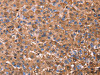 The image on the left is immunohistochemistry of paraffin-embedded Human liver cancer tissue using CSB-PA585877 (ERN2 Antibody) at dilution 1/40, on the right is treated with synthetic peptide. (Original magnification: ×200)