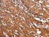 The image on the left is immunohistochemistry of paraffin-embedded Human gastric cancer tissue using CSB-PA585877 (ERN2 Antibody) at dilution 1/40, on the right is treated with synthetic peptide. (Original magnification: ×200)