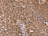 The image on the left is immunohistochemistry of paraffin-embedded Human ovarian cancer tissue using CSB-PA798292 (ESRRB Antibody) at dilution 1/40, on the right is treated with synthetic peptide. (Original magnification: ×200)