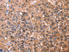 The image on the left is immunohistochemistry of paraffin-embedded Human liver cancer tissue using CSB-PA783827 (ESRRB Antibody) at dilution 1/40, on the right is treated with synthetic peptide. (Original magnification: ×200)