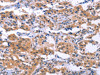 The image on the left is immunohistochemistry of paraffin-embedded Human thyroid cancer tissue using CSB-PA644588 (ESPL1 Antibody) at dilution 1/40, on the right is treated with synthetic peptide. (Original magnification: ×200)