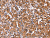 The image on the left is immunohistochemistry of paraffin-embedded Human thyroid cancer tissue using CSB-PA295592 (TDP2 Antibody) at dilution 1/40, on the right is treated with synthetic peptide. (Original magnification: ×200)