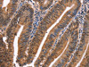 The image on the left is immunohistochemistry of paraffin-embedded Human colon cancer tissue using CSB-PA097491 (EVC2 Antibody) at dilution 1/40, on the right is treated with synthetic peptide. (Original magnification: ×200)
