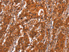 The image on the left is immunohistochemistry of paraffin-embedded Human gastic cancer tissue using CSB-PA934012 (GCG Antibody) at dilution 1/20, on the right is treated with synthetic peptide. (Original magnification: ×200)