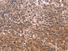 The image on the left is immunohistochemistry of paraffin-embedded Human cervical cancer tissue using CSB-PA165659 (GCG Antibody) at dilution 1/20, on the right is treated with synthetic peptide. (Original magnification: ×200)