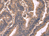 The image on the left is immunohistochemistry of paraffin-embedded Human colon cancer tissue using CSB-PA135172 (GCG Antibody) at dilution 1/20, on the right is treated with synthetic peptide. (Original magnification: ×200)