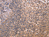 The image on the left is immunohistochemistry of paraffin-embedded Human cervical cancer tissue using CSB-PA135172 (GCG Antibody) at dilution 1/20, on the right is treated with synthetic peptide. (Original magnification: ×200)