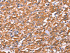 The image on the left is immunohistochemistry of paraffin-embedded Human thyroid cancer tissue using CSB-PA023220 (FAM13B Antibody) at dilution 1/20, on the right is treated with synthetic peptide. (Original magnification: ×200)