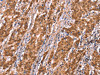 The image on the left is immunohistochemistry of paraffin-embedded Human gastric cancer tissue using CSB-PA023220 (FAM13B Antibody) at dilution 1/20, on the right is treated with synthetic peptide. (Original magnification: ×200)