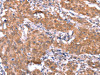 The image on the left is immunohistochemistry of paraffin-embedded Human gastric cancer tissue using CSB-PA790504 (FAM13B Antibody) at dilution 1/30, on the right is treated with synthetic peptide. (Original magnification: ×200)